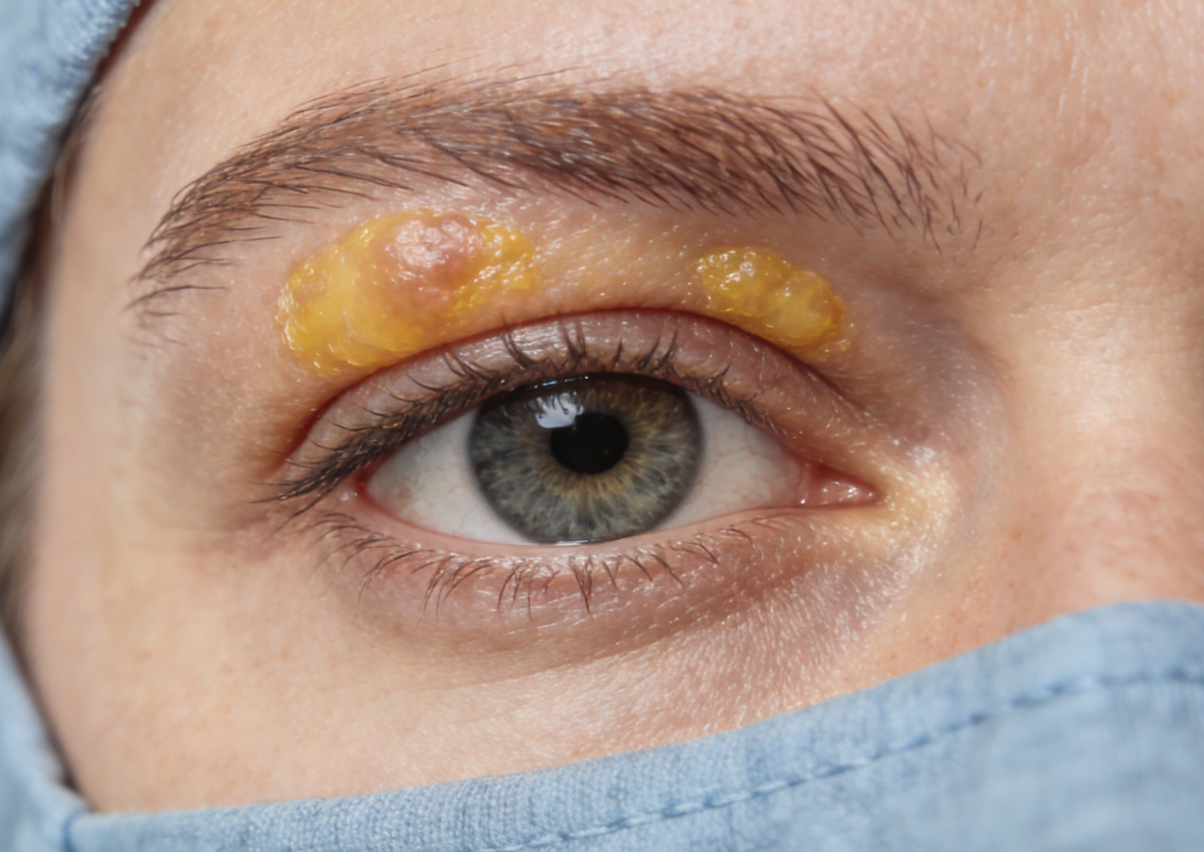 Analysis of Clinical Manifestations of Hyperlipidemia: Changes in the Eyes and Recognition of Skin Signals